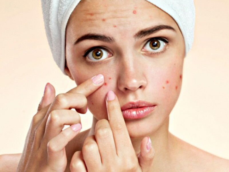 Những điều cần biết về BHA, điều trị mụn bằng BHA và ZnPCA
